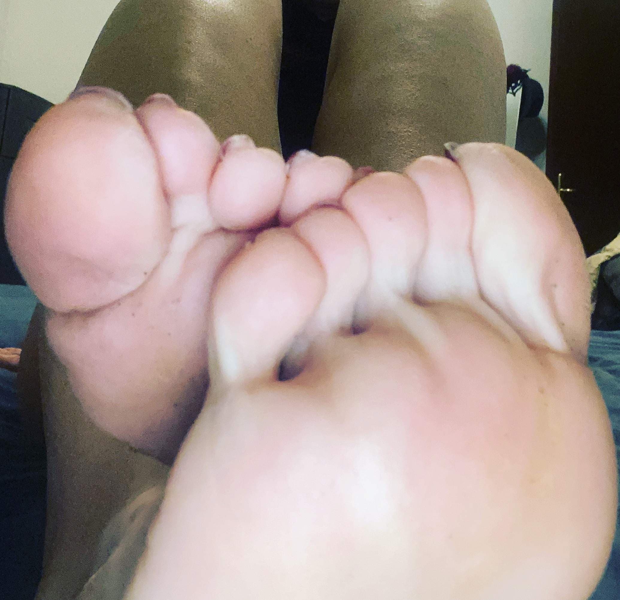 Vitiligo Babe