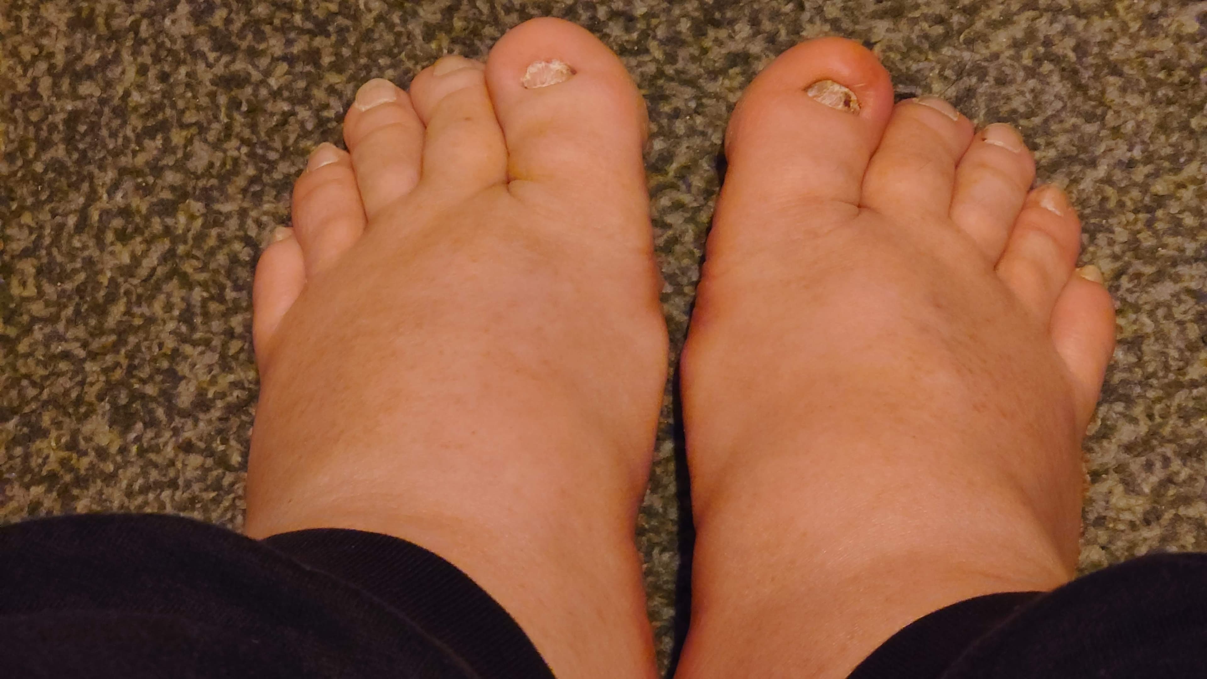 Fat feet.