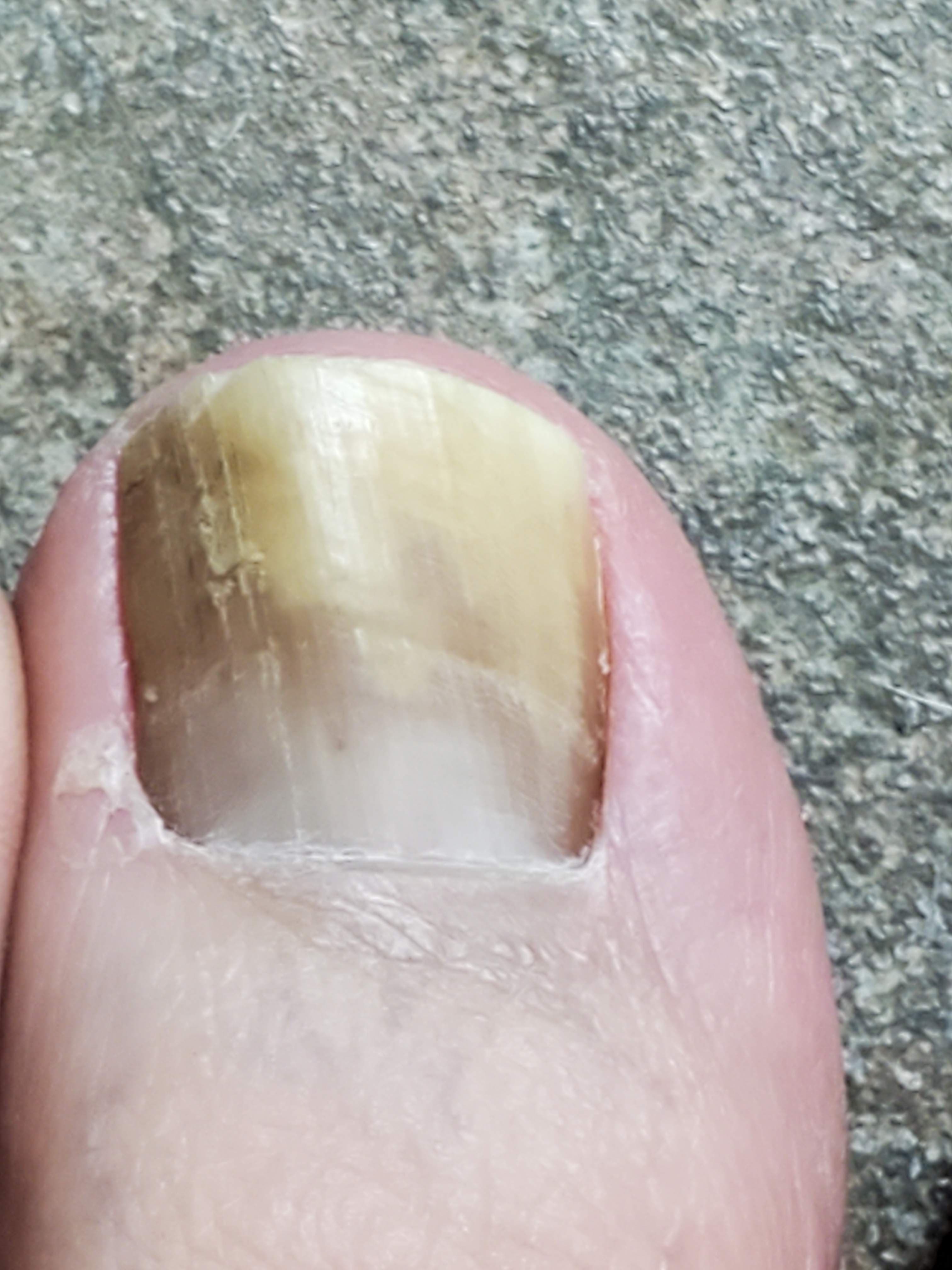 Yellow Toes