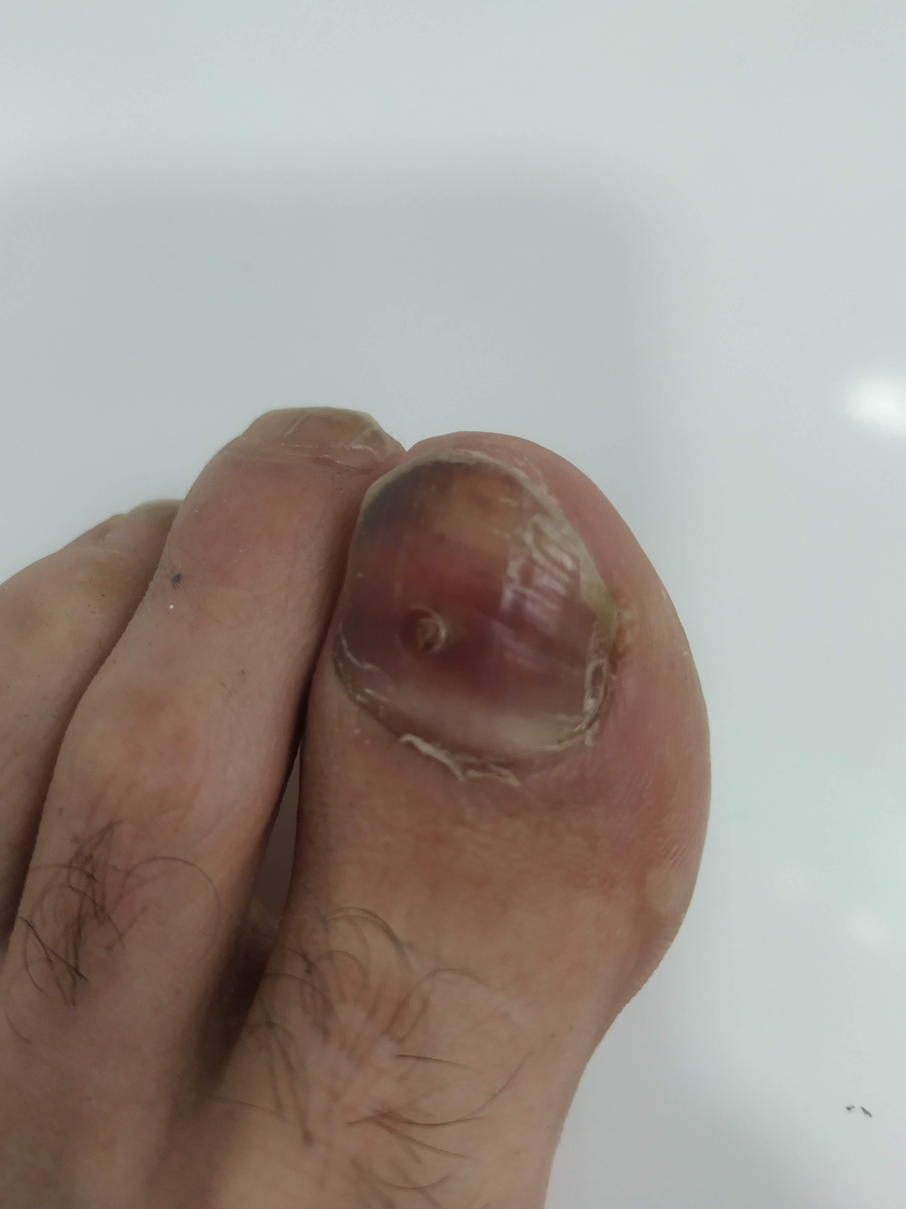Runner's feet and nails